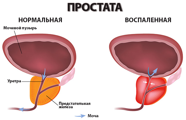 простатит