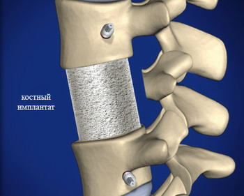 Корпорэктомия. Костный имплант